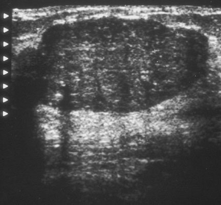 Листовидная фиброаденома молочной железы фото