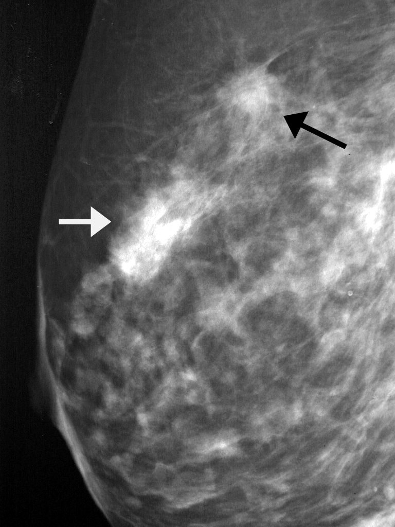 Маммография фкм. Фиброаденома молочной железы маммограмма. Фиброаденоз маммография. Фиброаденома молочной железы на маммографии УЗИ. Склерозирующий аденоз.